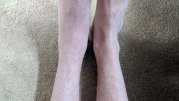 Kemunduran otot betis setelah patah tumit kiri Foto: Brightside