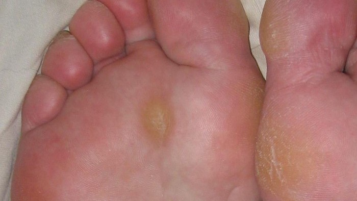 10 Cara Menghilangkan Kapalan di Kaki dengan Cepat di Rumah