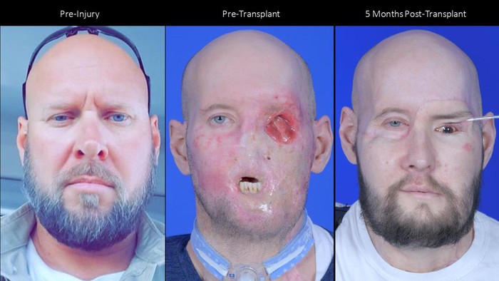 Setelah operasi, James akan melanjutkan rehabilitasi rawat jalan termasuk terapi fisik, okupasi, dan wicara.