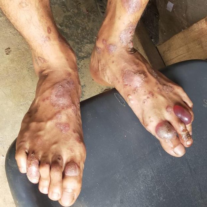 Penampakan kondisi pasien cacar monyet di Batam. (Dok Dinkes Kota Batam)