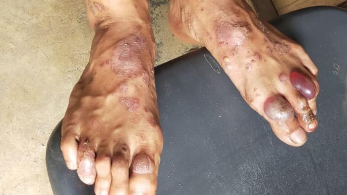 Ciri-ciri Cacar Monyet, Gejala, Penyebab, dan Penanganannya