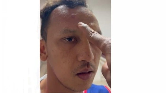 Kondisi kepala Rachmat Hidayat. (Foto: Istimewa).