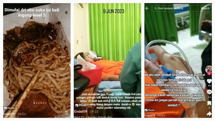 Awal Mula Wanita Kena Fistula Ani, Dubur Bernanah karena Ogah Makan Sayur