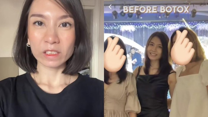 Before-After Viral Wanita Gagal Botox Berujung Tak Bisa Tertawa 4 Bulan