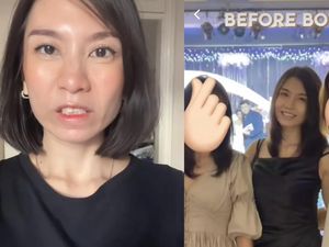 Viral Dialami Wanita Solo, Ini yang Bisa Terjadi pada Wajah akibat Gagal Botox