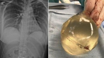 Pada tahun 2018, implan payudara silikon menyelamatkan seorang wanita dari peluru yang ditembakkan dari jarak dekat di Kanada. Dokter mencatat bahwa implan tersebut membelokkan lintasan peluru, sehingga menyelamatkan nyawa wanita tersebut. Satu-satunya luka yang dialaminya hanyalah patah tulang rusuk. Tidak ada kerusakan pada organ vitalnya. Foto: Boredpanda