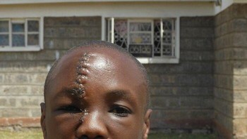 Pada tahun 2012, seorang pria Kenya berusia 24 tahun yang bekerja di panti asuhan bernama Anthony Omari terbangun dan menemukan 3 preman bersenjatakan parang menerobos masuk. Dia menyerang ketiga pria tersebut sekaligus dan mengejar mereka keluar, di mana perkelahian berlanjut. Namun sayang, Anthony justru menikam wajahnya dengan parang. Meskipun demikian, ia berhasil melawan para penyerang, memastikan keselamatan anak-anak, dan kemudian pingsan. Untungnya, dia selamat tetapi membutuhkan jahitan untuk luka sepanjang 11 inci di wajahnya. Foto: Boredpanda
