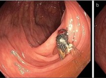 Lalat Hidup Ditemukan dalam Usus Kakek 63 Tahun, Dokter sampai Kebingungan