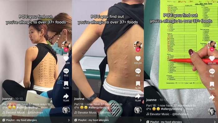 Viral Cerita Wanita yang Alergi 37 Makanan, Mengaku Tersiksa karena Ini