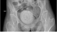 Jurnal Urology Case Reports mempublikasi kasus yang terjadi pada wanita muda berusia 27 tahun. Ia mengeluhkan sulit menahan buang air kecil, penurunan nafsu makan, muntah, hingga sakit perut yang parah. Setelah diperiksa, ternyata ada batu seukuran jeruk besar di antara organ panggulnya. Batu vagina yang bersarang di antara organ panggulnya itu sangat besar, sehingga menekan kandung kemihnya. (Foto: Jurnal Urology Case Reports).