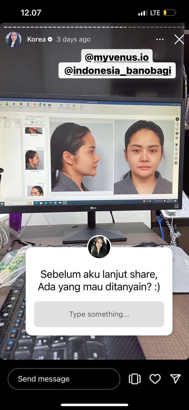 Sebelum menjalani operasi wajah Mawar tentunya dipotret terlebih dahulu dari berbagai angle untuk nantinya dijadikan perbandingan. Terlihat wajah asli Mawar tanpa pulasan makeup sedikitpun sebelum menjalani operasi plastik. Foto: Instagram/@mysamawar