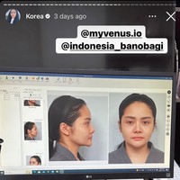 Sebelum menjalani operasi wajah Mawar tentunya dipotret terlebih dahulu dari berbagai angle untuk nantinya dijadikan perbandingan. Terlihat wajah asli Mawar tanpa pulasan makeup sedikitpun sebelum menjalani operasi plastik. Foto: Instagram/@mysamawar