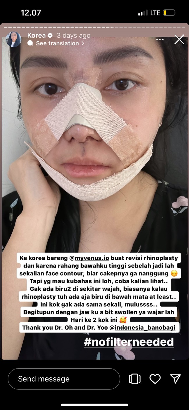 Melalui akun Instagram pribadinya Mawar membagikan potret wajahnya yang masih terbalut perban setelah oplas. Di keterangannya ia mengatakan bahwa prosedur yang dijalaninya ialah revisi rhinoplasty dan face countour. Foto: Instagram/@mysamawar
