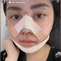 Melalui akun Instagram pribadinya Mawar membagikan potret wajahnya yang masih terbalut perban setelah oplas. Di keterangannya ia mengatakan bahwa prosedur yang dijalaninya ialah revisi rhinoplasty dan face countour. Foto: Instagram/@mysamawar