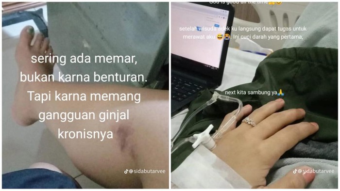 Viral Wanita Gagal Ginjal Kronis Diduga gegara Sering Minum Obat, Dokter Bilang Gini