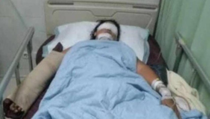 Nurlaela, istri siri yang disiksa suaminya hingga buta di Bangka.
