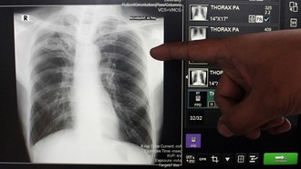 Fakta-fakta Klaim Sesat Influencer Sebut Herbal Bisa Cegah-Obati TBC