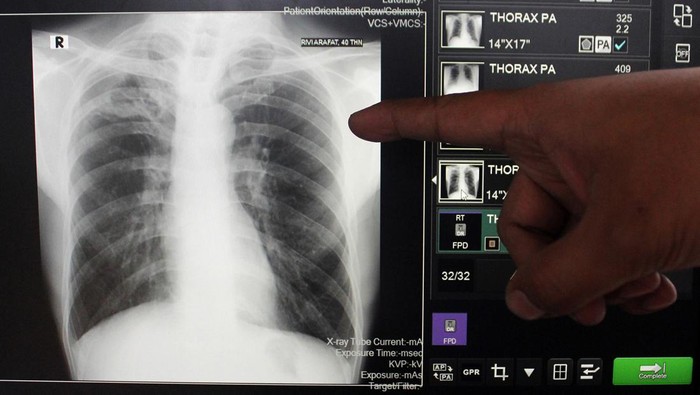 Layanan keliling deteksi TBC gratis di Medan
Warga melakukan rontgen toraks paru saat pelaksanaan layanan keliling deteksi tuberkulosis (TBC) di UPT Pukesmas Belawan, Medan, Sumatera Utara, Jumat (1/12/2023). Pemerintah Kota Medan bekerja sama dengan rumah sakit daerah setempat menggelar layanan keliling deteksi TBC gratis bagi warga Kota Medan dengan tujuan siaga terhadap penyakit menular seperti TB dan HIV.