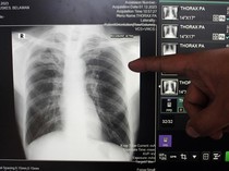 TBC di Indonesia Tembus 1 Juta Kasus, Warga Diminta Tak Takut Berobat