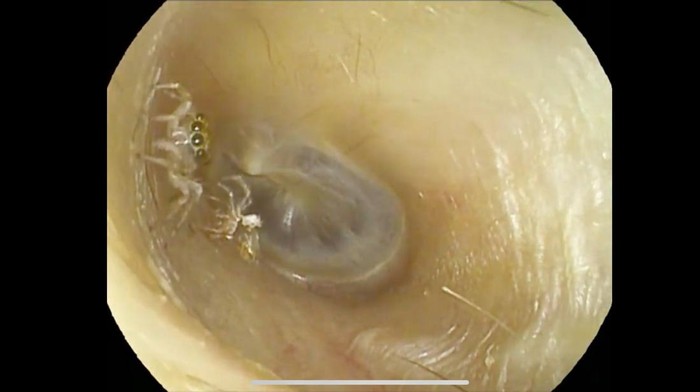 Bikin Merinding, Viral Laba-laba Hidup dan Ganti Kulit di Telinga Wanita Ini