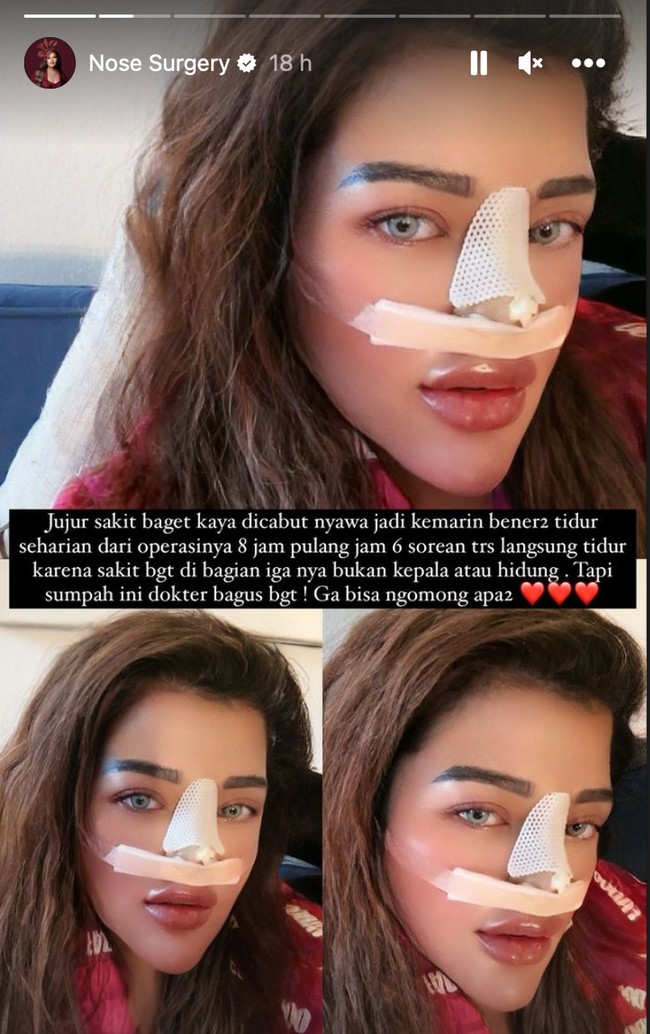 Terbaru melalui akun Instagramnya Shindy membagikan dirinya yang  menjalani rhinoplasty atau oplas hidung. Dengan hidung yang masih terbungkus perban Shindy pun memamerkan penampilannya setelah oplas. Foto: Instagram/@rendyshindy_samuel