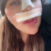 Operasi hidung tersebut diketahui dijalani Shindy di sebuah klinik kecantikan di California, Amerika Serikat. Walaupun kesakitan setelah menjalani operasi namun Shindy optimis hasilnya akan memuaskan. Foto: Instagram/@rendyshindy_samuel