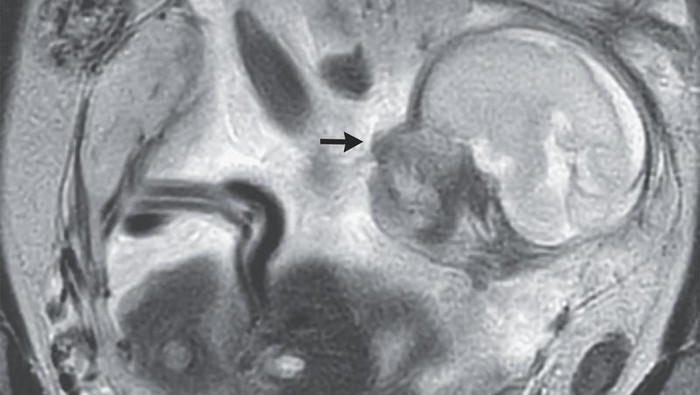 Wanita Ini Ngeluh Sakit Perut-Kembung 10 Hari, Ternyata Ada Bayi di Dekat Ususnya