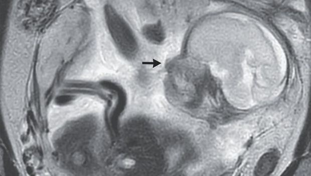 Wanita Ini Ngeluh Sakit Perut-Kembung 10 Hari, Ternyata Ada Bayi di Dekat Ususnya