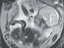 Wanita Ini Ngeluh Sakit Perut-Kembung 10 Hari, Ternyata Ada Bayi di Dekat Ususnya