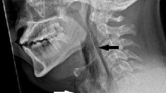 Ngilu Banget! Tenggorokan Pria Umur 30-an Terkoyak Akibat Menahan Bersin