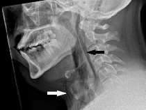 Ngilu, Tenggorokan Pria Ini Robek Disebut gegara Sering Nahan Bersin