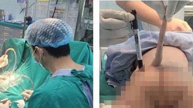 Bayi 4 bulan terlahir dengan 'ekor', panjanganya 14 Cm.