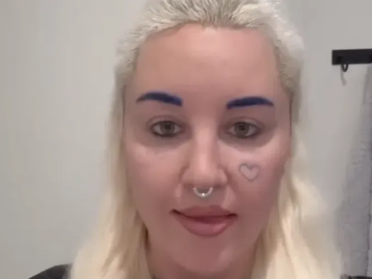 Foto Baru Amanda Bynes Setelah Operasi Lipatan Mata, Hampir Tak Dikenali