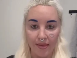 Foto Baru Amanda Bynes Setelah Operasi Lipatan Mata, Hampir Tak Dikenali