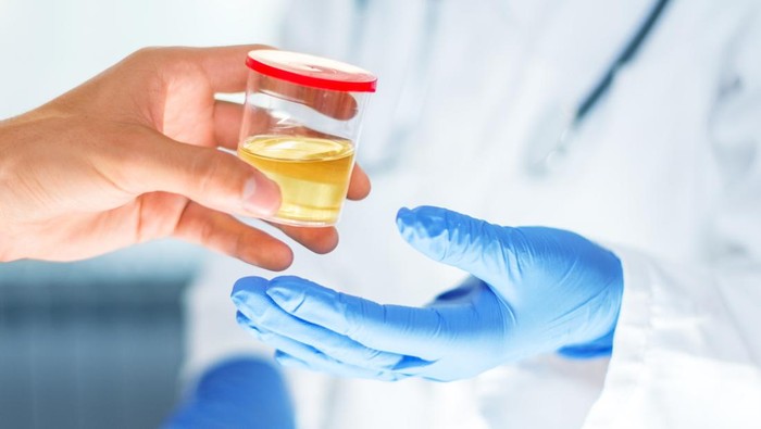 Ahli Bedah Ungkap Warna Urine dan Artinya pada Kondisi Kesehatan Tubuh