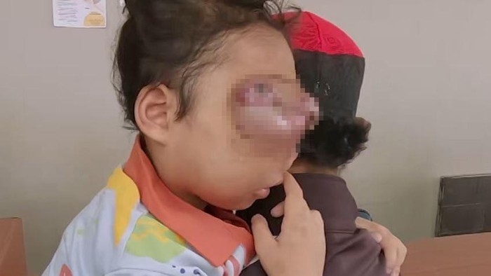 Berawal dari gatal di area mata, Assyfa didiagnosa menderita Massa Cavum Nasi Dextra atau tumor rongga hidung