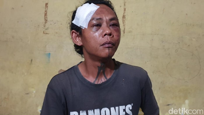 Petugas parkir di Megapark, Jalan Kapten Muslim, Kecamatan Helvetia, Kota Medan, dianiaya sejumlah pria cepak. Alhasil, kepalanya terluka dan areal matanya lebam. (Goklas Wisely/detikSumut).