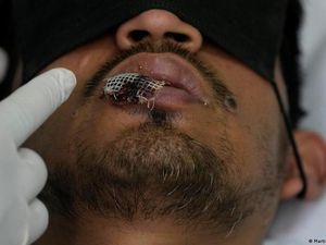 Ini Kelompok dan Usia yang Banyak Terpapar Mpox