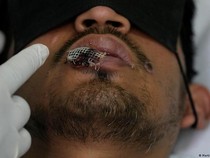 Ini Kelompok dan Usia yang Banyak Terpapar Mpox