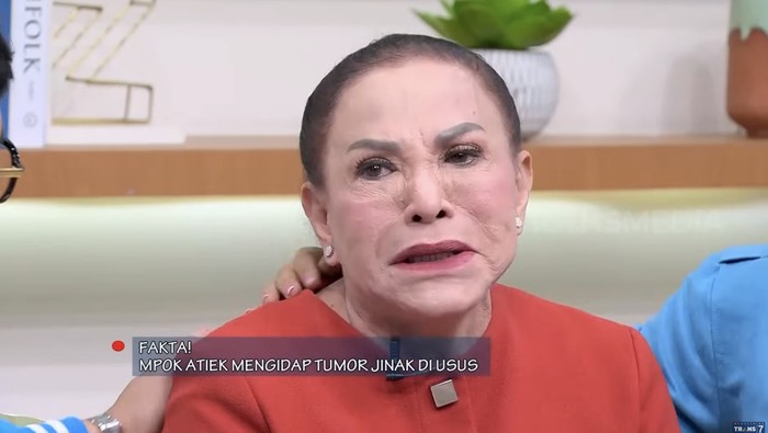 Mpok Atiek menangis idap tumor jinak di usus.