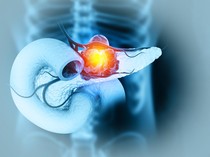 Dikira Sakit Punggung Biasa, Pria Ini Ternyata Idap Kanker Pankreas