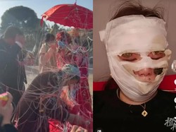 Viral Kisah Pengantin Pakai Semprotan Pesta, Mau Meriah Wajah Malah Terbakar