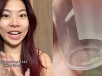 Ada Tauge Nyangkut di Tenggorokannya, Wanita Ini Habiskan 9 Jam di Rumah Sakit