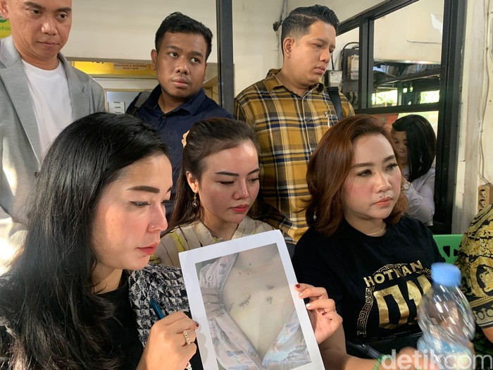 Merry (20) korban dugaan KDRT oleh inisial AG terkait kekerasan dalam rumah tangga (KDRT) berupa penusukan di Tol Cikampek. (Mulia Budi/detikcom)