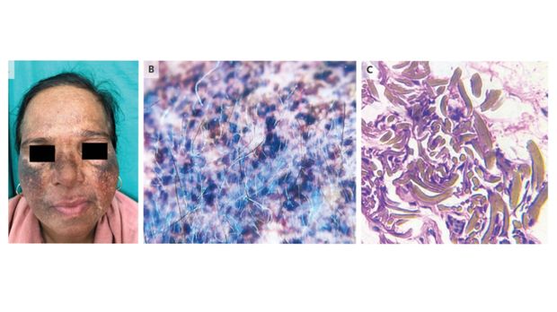 Muka Wanita Ini Rusak Parah usai Pakai Krim Abal-abal Mengandung Hidrokuinon Muka Wanita Ini Rusak Parah usai Pakai Krim Abal-abal Mengandung Hidrokuinon