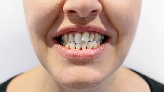 Dokter Ungkap Kebiasaan Masa Kecil yang Bikin Gigi Berantakan saat Dewasa