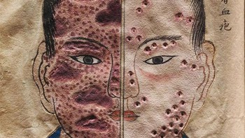 Ilustrasi Menakjubkan Dari Buku Kedokteran Jepang Tahun 1720 Tentang Cacar, Yang Dengan Cerdik Menggunakan Kertas Timbul Untuk Menunjukkan Perubahan Tekstur Lesi Cacar Selama Berbagai Tahap Penyakit Foto: Boredpanda