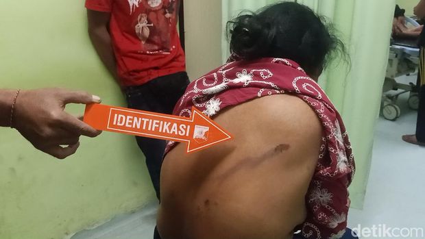 Kondisi salah seorang korban tersambar petir di Jembrana, Bali.