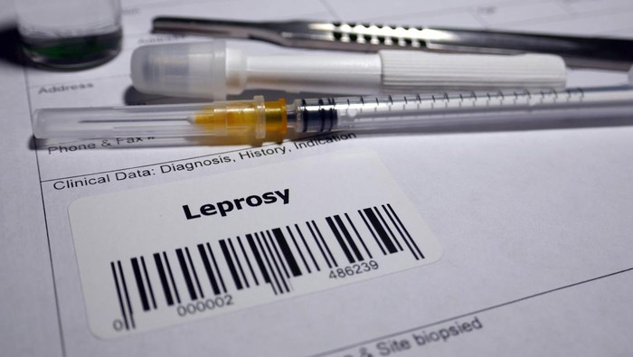 Kusta Intai Segala Usia, Pasien Termuda di Bekasi 12 Tahun