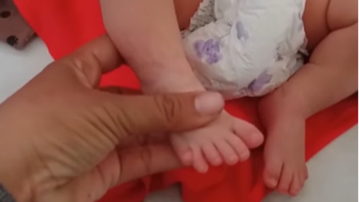 Bayi Sampang lahir dengan 6 jari di masing-masing tangan dan kaki.